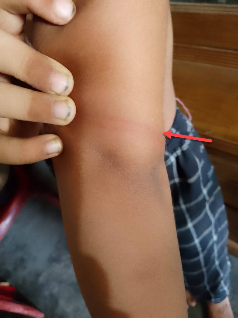গাজীপুর ভবানীপুর বাইতুল উলূম হিফয মাদ্রাসায় শিশু নিরযাতন 1 ৮ বছরের শিশু মাদ্রাসায় হুজুরের কাছে নিরযাতিত হবার প্রায় দু সপ্তাহ পরের ফটো